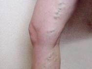 Упражнения при тромбозе глубоких вен нижних конечностей Гимнастика после операции тромбофлебит ноги